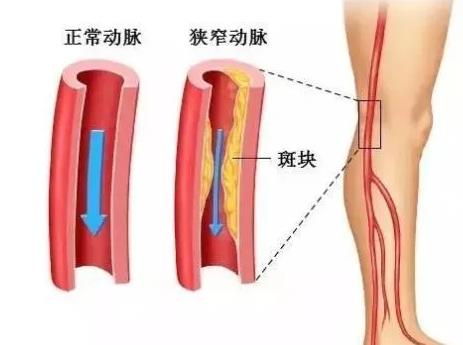 無創(chuàng)動脈硬化檢測你做過嗎,？