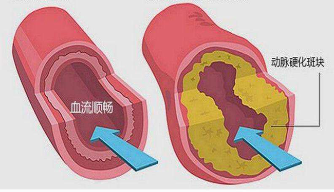 做好動(dòng)脈硬化檢測,，降低冠心病發(fā)病率